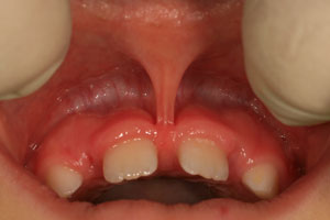 Короткая, широкая уздечка верхней губы, вплетающаяся между центральными постоянными резцами и приводящая к формированию диастемы.