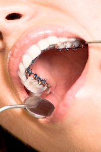 Лингвальные брекеты Лингвальные брекеты